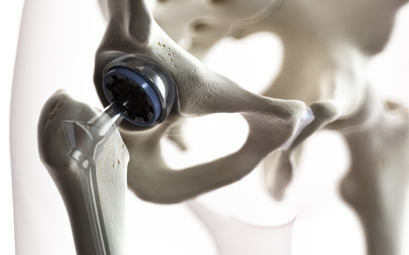 Combien De Temps Dure Une Prothèse De Hanche Actualités de la hanche | Cabinet de chirurgie traumatologique | Paris