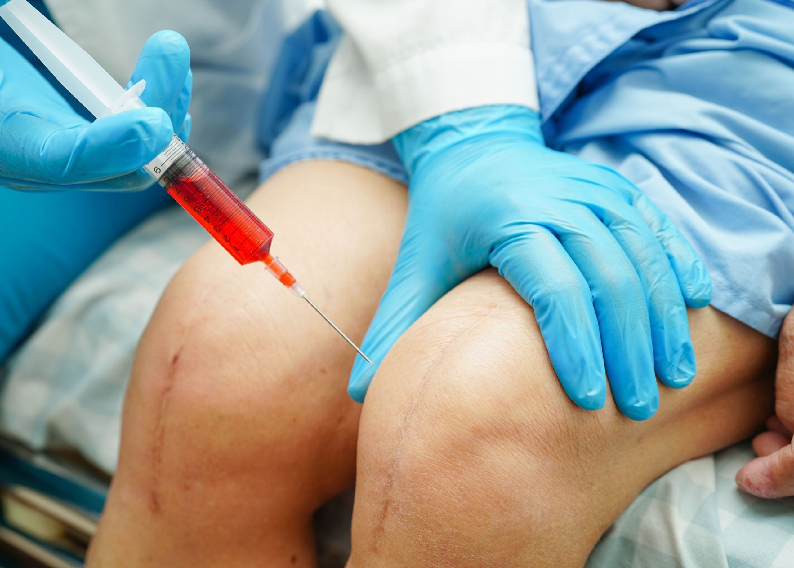 Injections plaquettaires à Paris | Rendez vous orthopédiste | Cabinet de chirurgie orthopédique