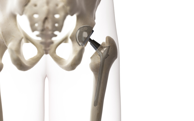 PTH-Prothèse-totale-de-hanche-Dr-Jaballah-Paris-Orthopédiste