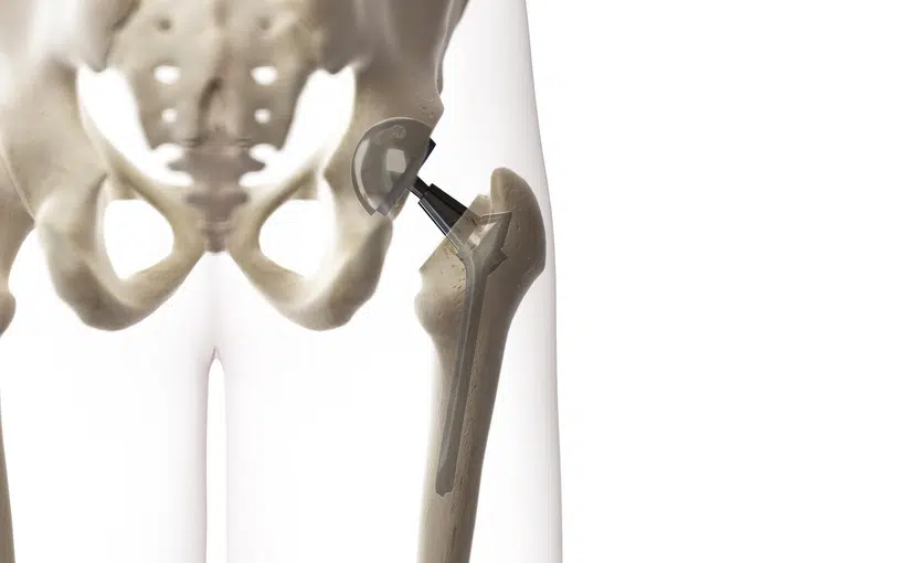 PTH Prothèse totale de hanche Dr Jaballah Paris Orthopédiste 1