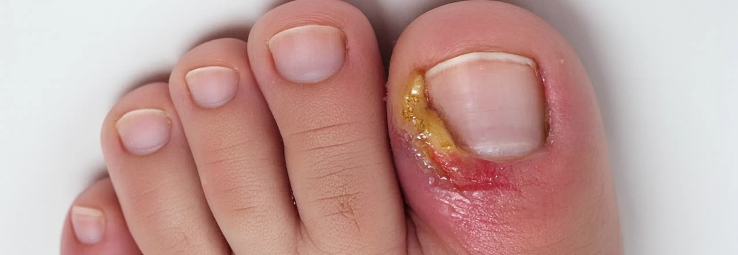 Ongle incarné infecté avancé avec pus abondant et forte inflammation du sillon interne.