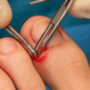 Chirurgie de l’ongle incarné : déroulement, techniques et suites