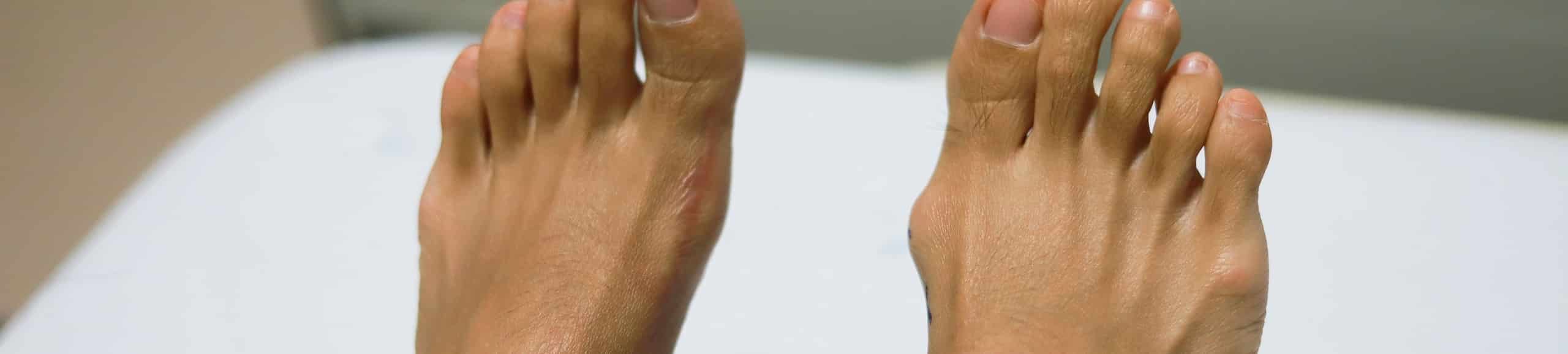 Pieds présentant un hallux valgus bilatéral avec déviation du gros orteil et bosse interne visible.