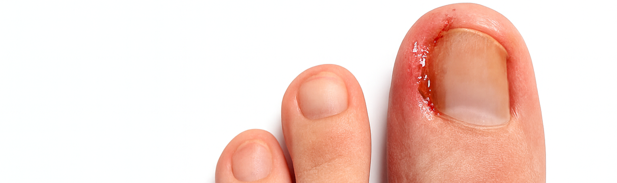Ongle incarné : symptômes, causes, traitements et chirurgie