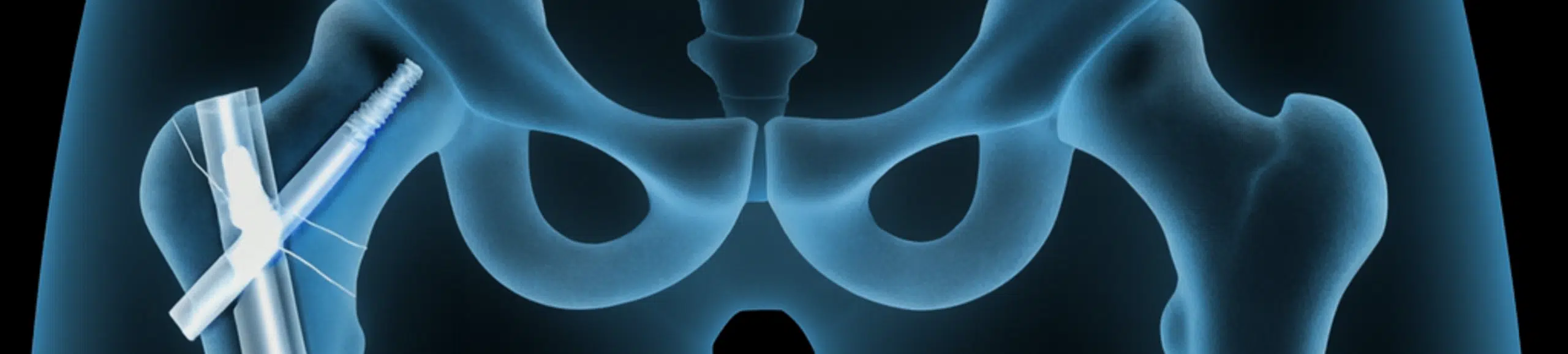 Radiographie de la hanche montrant une ostéosynthèse par clou Gamma dans une fracture pertrochantérienne.