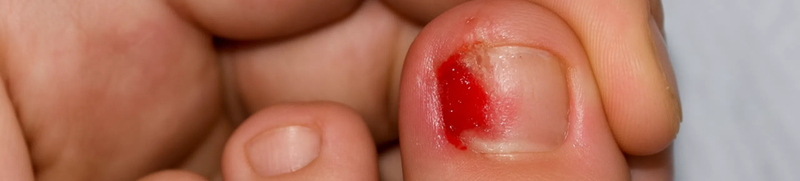 Gros orteil présentant une zone rouge et suintante sur le bord de l’ongle, tenu entre les doigts d’un patient