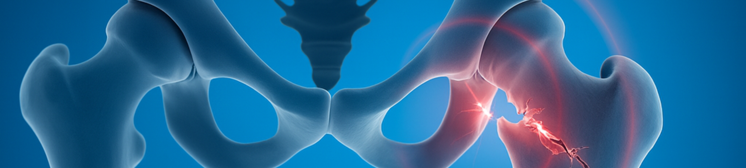 Illustration 3D d’une fracture pertrochantérienne du fémur, montrant la zone de cassure sous le col du fémur.