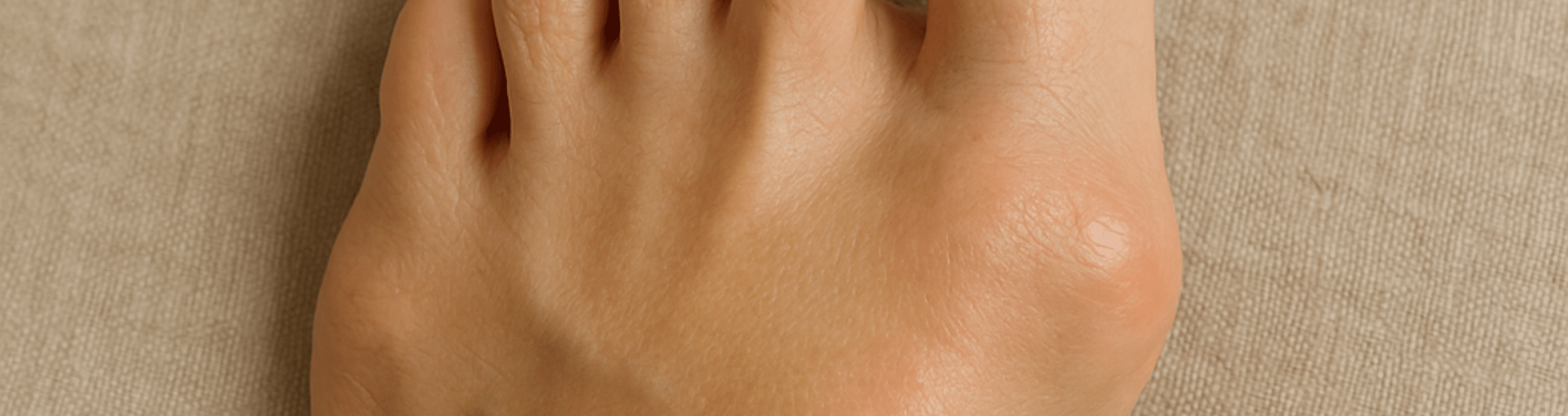 Hallux rigidus : bosse dorsale douloureuse sur le gros orteil