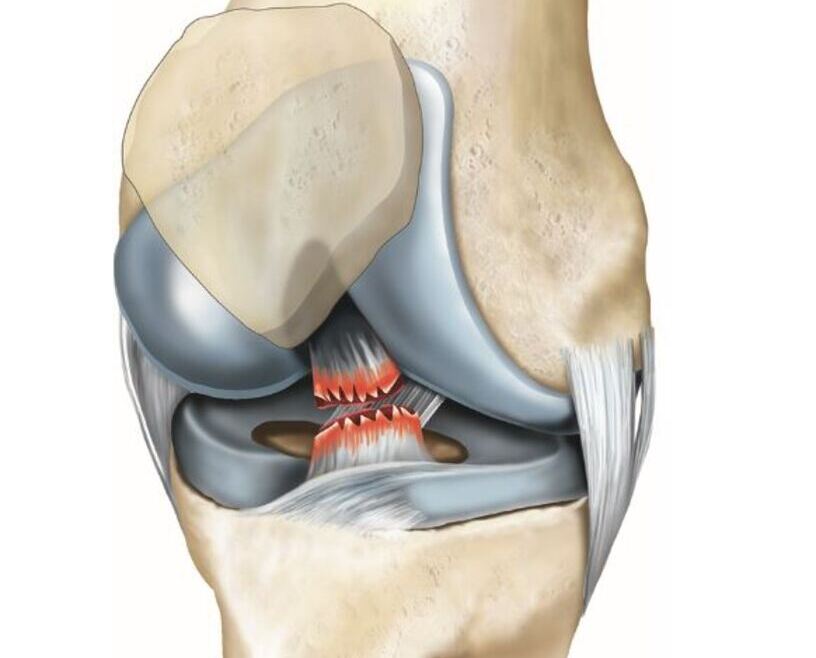 Illustration anatomique du genou montrant les ligaments croisés antérieur et postérieur entre le fémur et le tibia