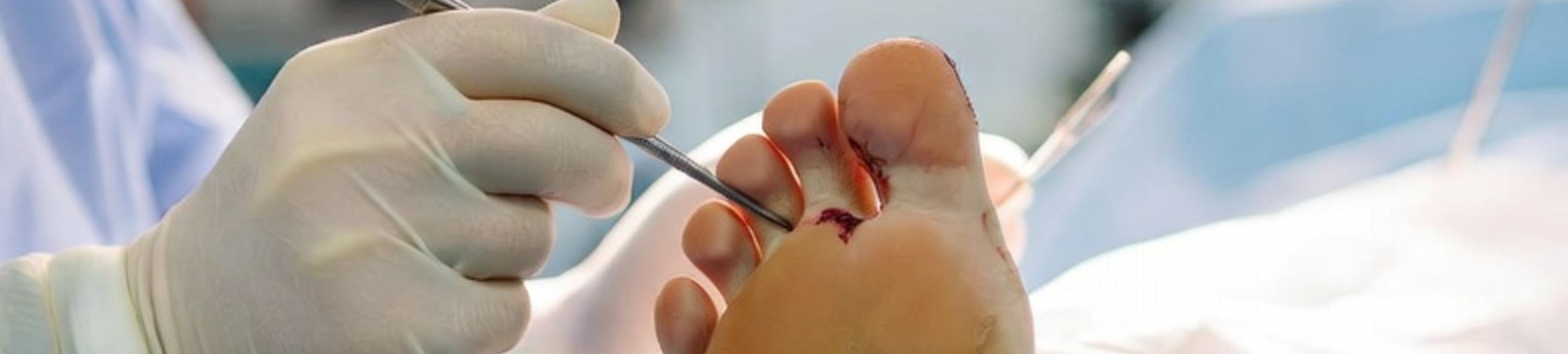 Chirurgie de l’hallux valgus en bloc opératoire, correction du gros orteil avec technique mini-invasive