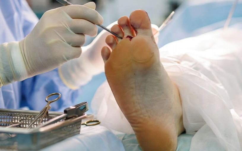 Chirurgie de l’hallux valgus en bloc opératoire, correction du gros orteil avec technique mini-invasive