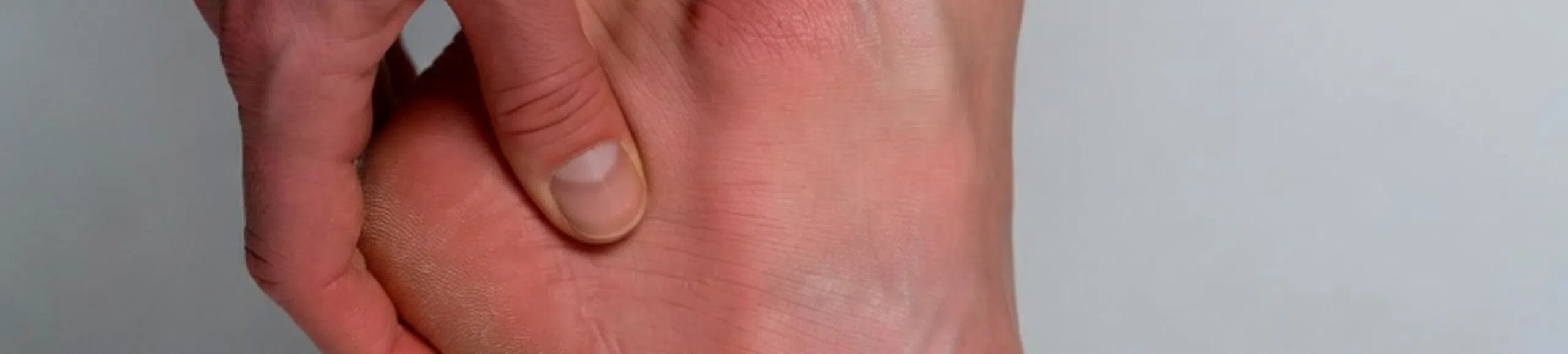 Douleur au talon avec inflammation lors de l’appui du pied