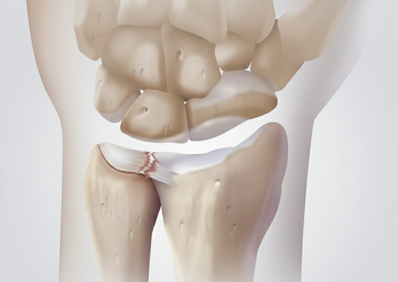 Illustration du poignet montrant une lésion du TFCC au niveau radio-ulnaire distal