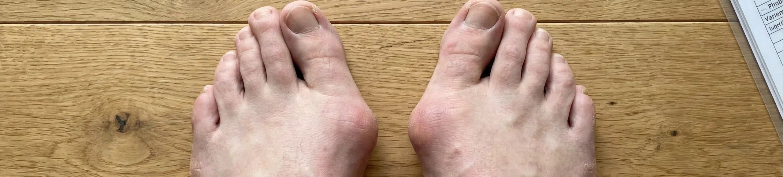 Hallux abducto valgus bilatéral avec déviation du gros orteil vers l’extérieur et saillie médiale de la tête du premier métatarsien