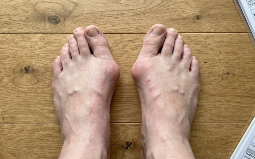 Hallux abducto valgus bilatéral avec déviation du gros orteil vers l’extérieur et saillie médiale de la tête du premier métatarsien