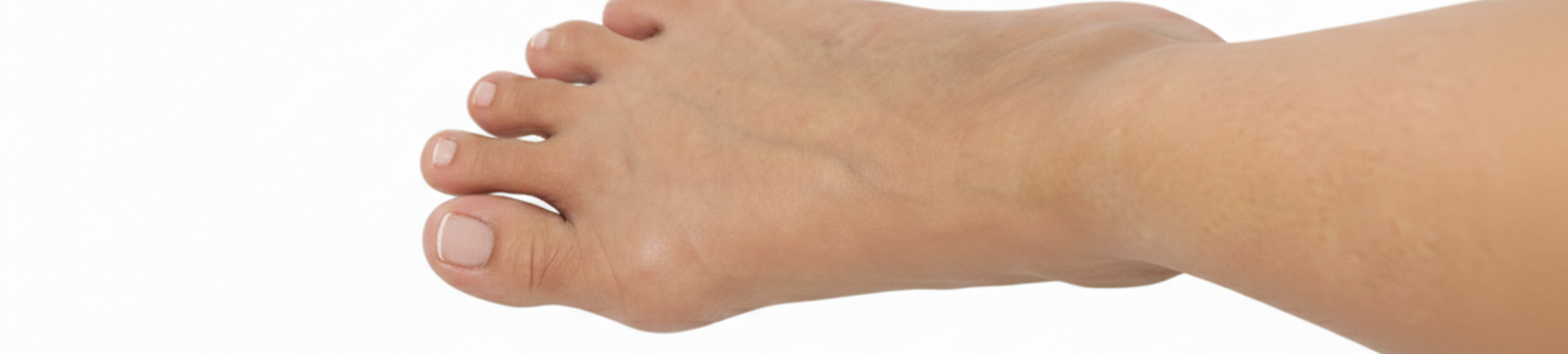 Pied présentant un hallux abducto valgus léger avec déviation du gros orteil