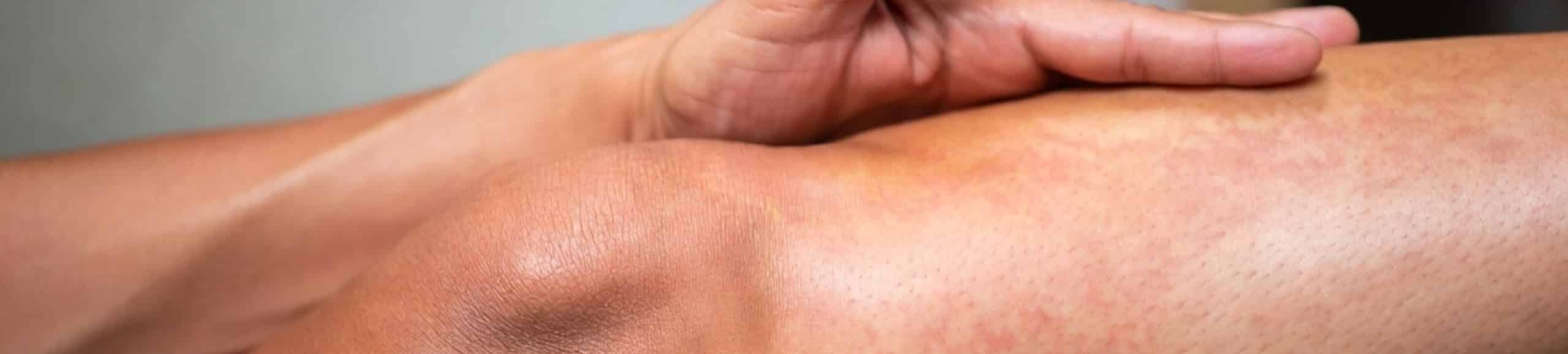 Personne tenant son genou avec une douleur irradiant dans la jambe, montrant une inflammation de la face antérieure du tibia.