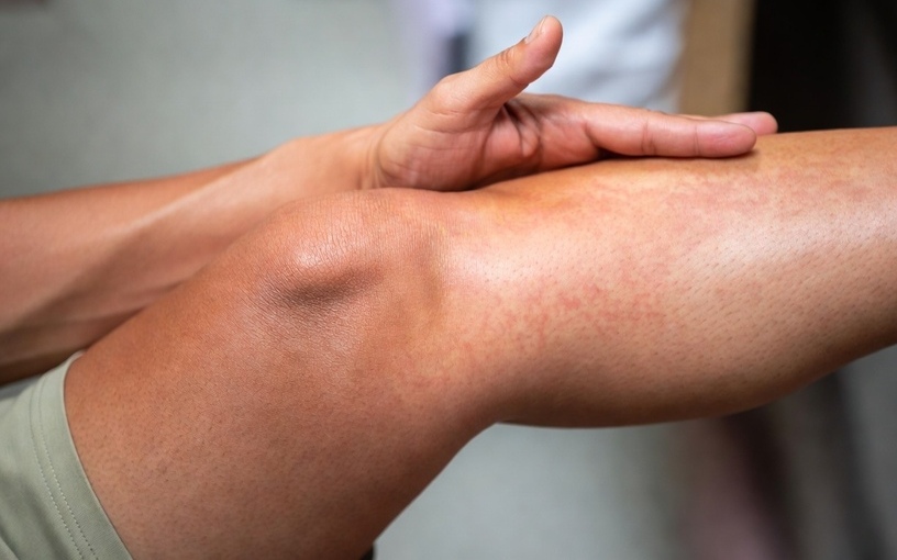 Personne tenant son genou avec une douleur irradiant dans la jambe, montrant une inflammation de la face antérieure du tibia.