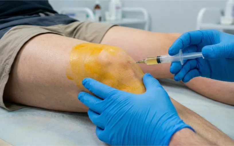 Ponction du genou en consultation avec aspiration du liquide articulaire sous conditions d’asepsie